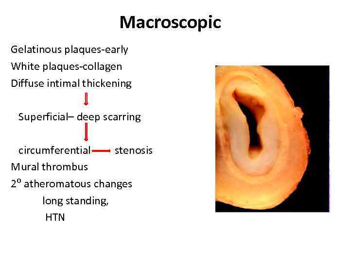 Macroscopic Gelatinous plaques-early White plaques-collagen Diffuse intimal thickening Superficial– deep scarring circumferential stenosis Mural