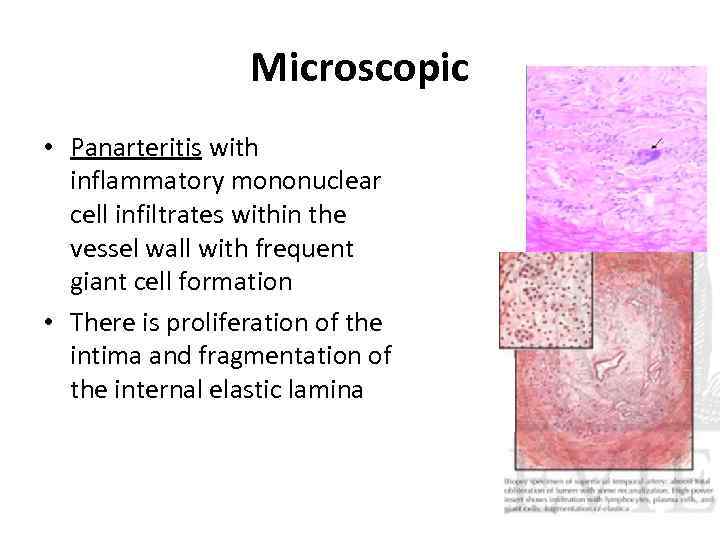 Microscopic • Panarteritis with inflammatory mononuclear cell infiltrates within the vessel wall with frequent