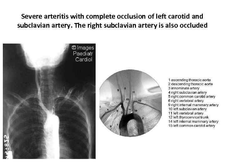 Severe arteritis with complete occlusion of left carotid and subclavian artery. The right subclavian