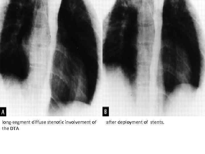 long-segment diffuse stenotic involvement of the DTA after deployment of stents. 