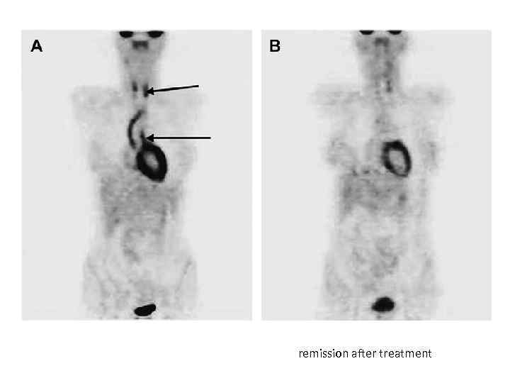 remission after treatment 