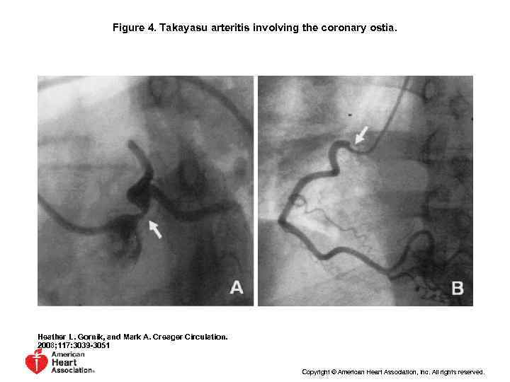 Figure 4. Takayasu arteritis involving the coronary ostia. Heather L. Gornik, and Mark A.