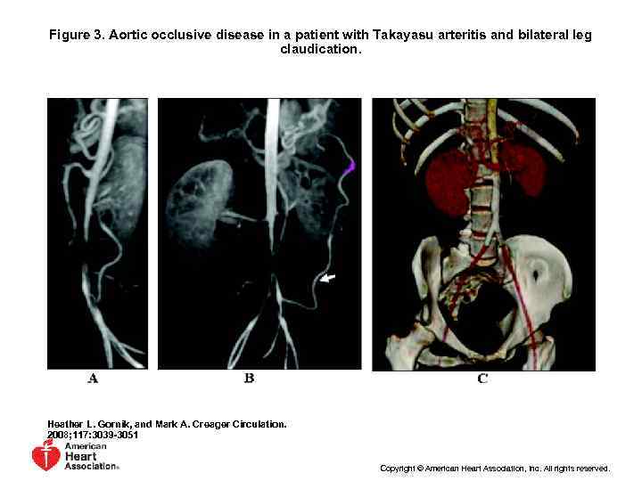 Figure 3. Aortic occlusive disease in a patient with Takayasu arteritis and bilateral leg