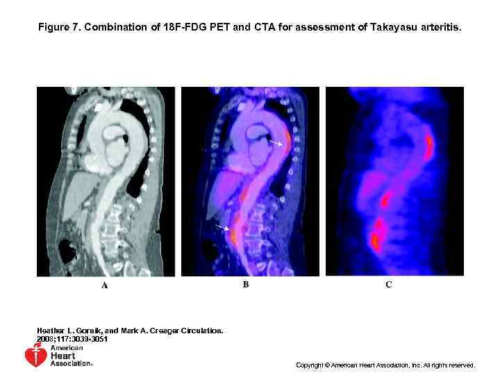 Figure 7. Combination of 18 F-FDG PET and CTA for assessment of Takayasu arteritis.