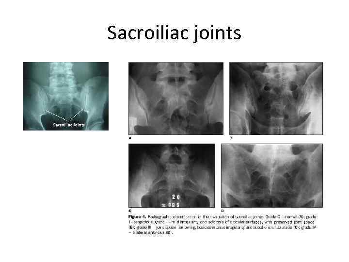 Sacroiliac joints 