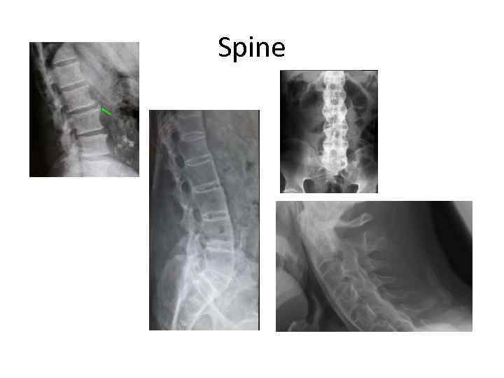Spine 
