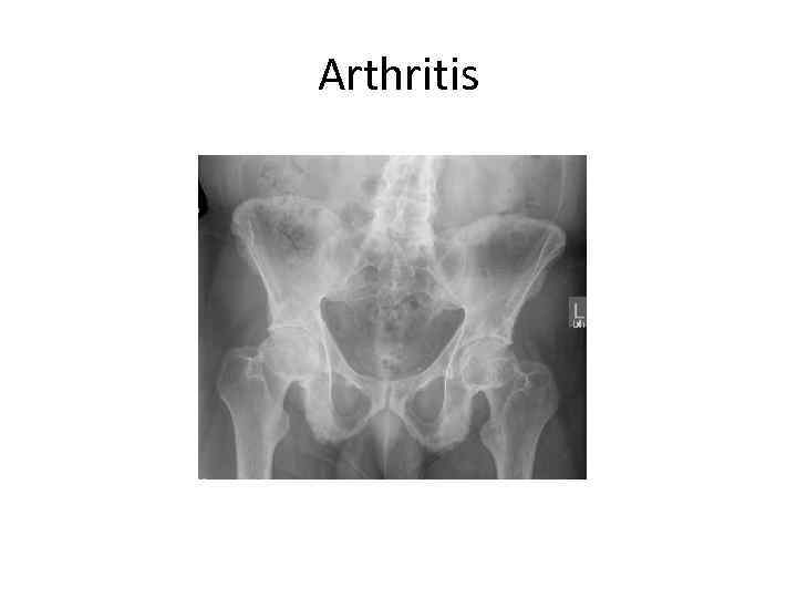 Arthritis 