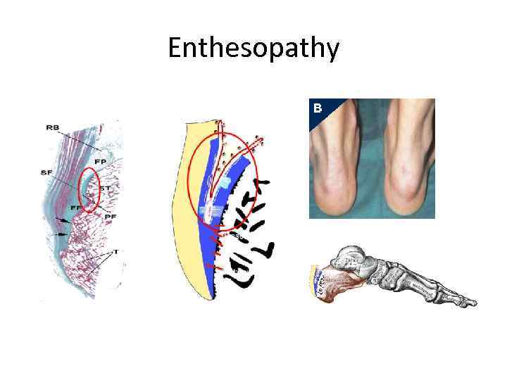 Enthesopathy 
