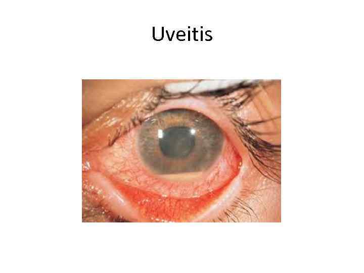Uveitis 