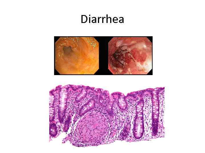 Diarrhea 