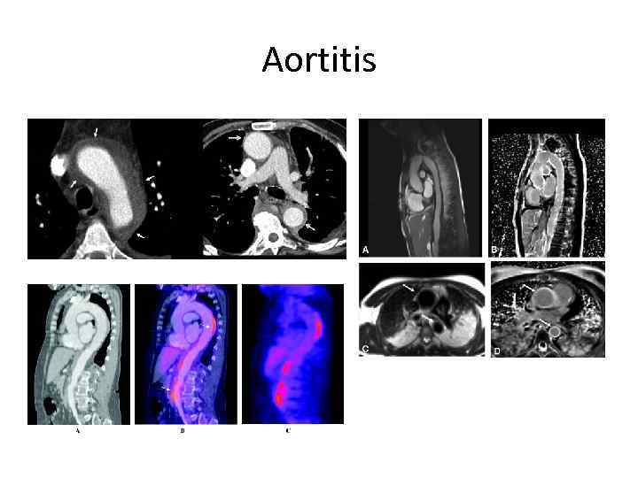 Aortitis 