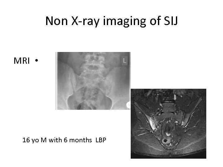 Non X-ray imaging of SIJ MRI • 16 yo M with 6 months LBP