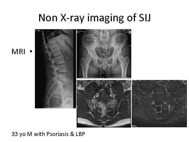 Non X-ray imaging of SIJ MRI • 33 yo M with Psoriasis & LBP