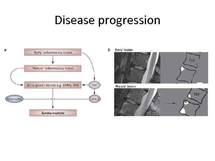 Disease progression 