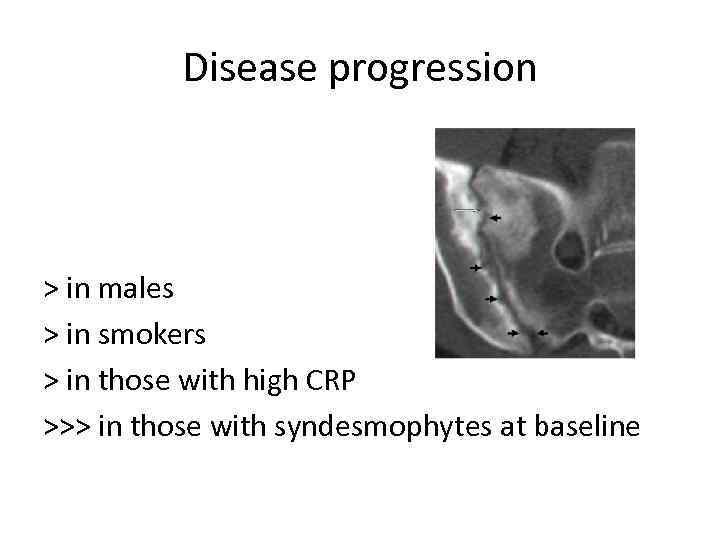 Disease progression > in males > in smokers > in those with high CRP