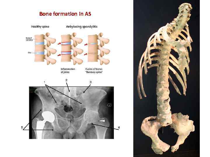 Bone formation in AS 