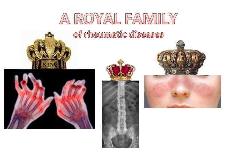 A ROYAL FAMILY of rheumatic diseases 