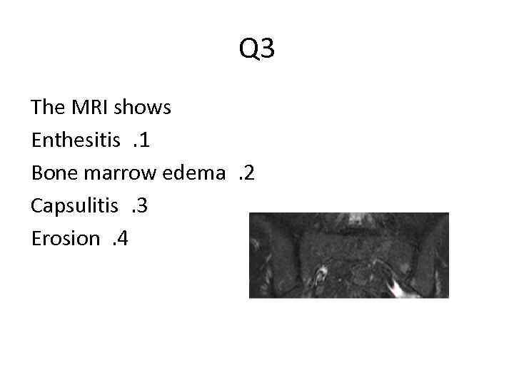 Q 3 The MRI shows Enthesitis. 1 Bone marrow edema. 2 Capsulitis. 3 Erosion.