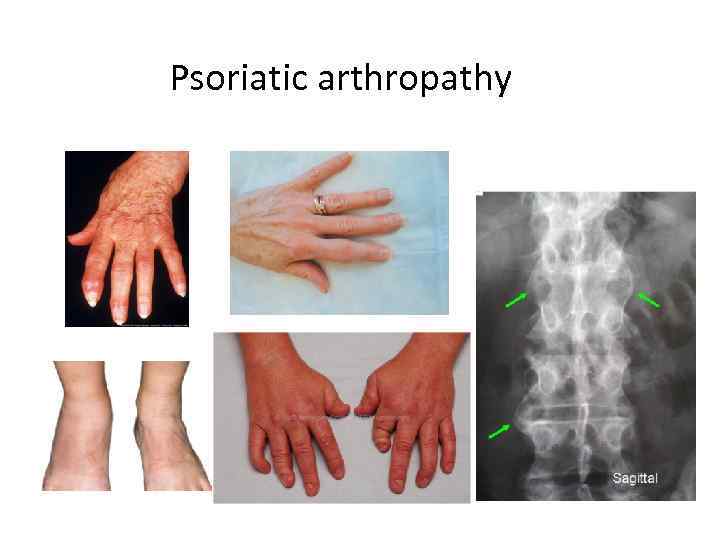 Psoriatic arthropathy 
