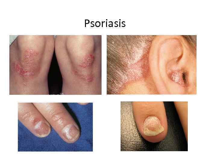 Psoriasis 