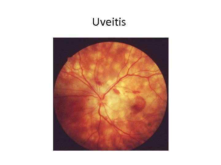 Uveitis 