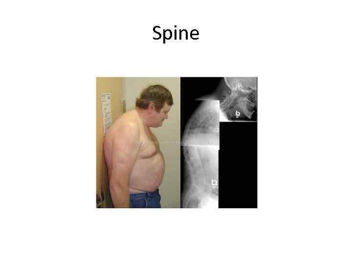 Spine 