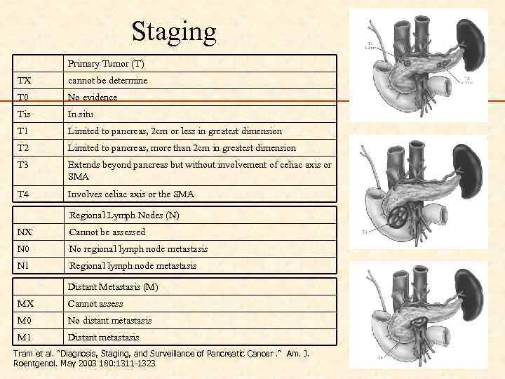 Staging Primary Tumor (T) TX cannot be determine T 0 No evidence Tis In