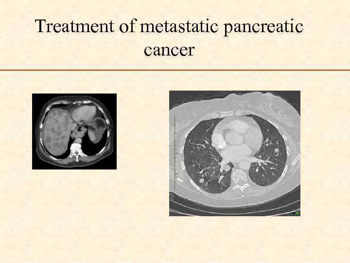 Treatment of metastatic pancreatic cancer 