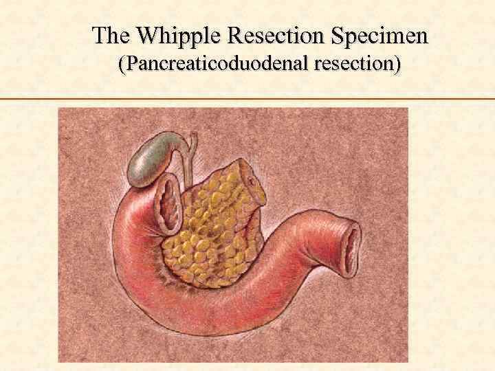 The Whipple Resection Specimen (Pancreaticoduodenal resection) 