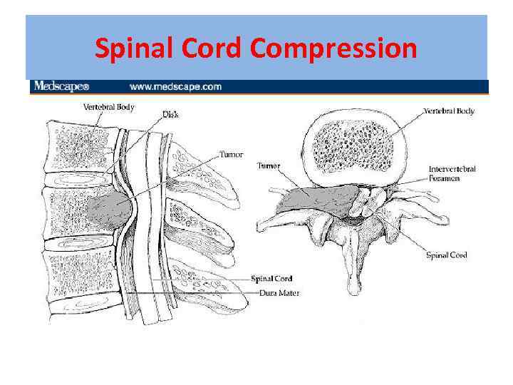 Spinal Cord Compression 