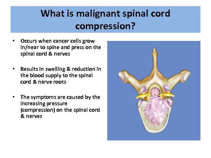 What is malignant spinal cord compression? • Occurs when cancer cells grow in/near to