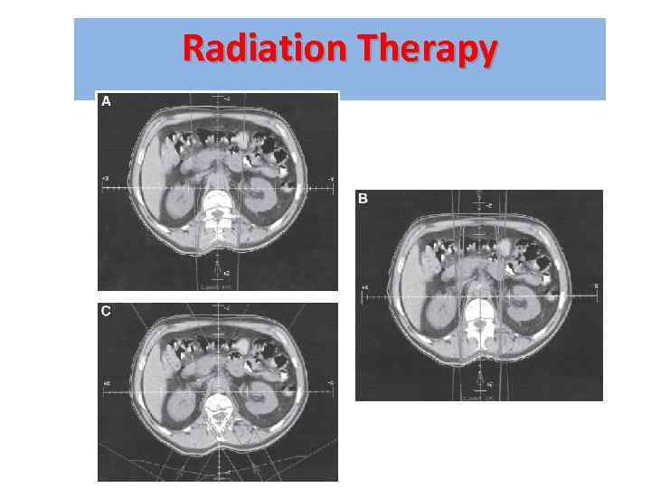 Radiation Therapy 