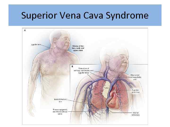 Superior Vena Cava Syndrome 