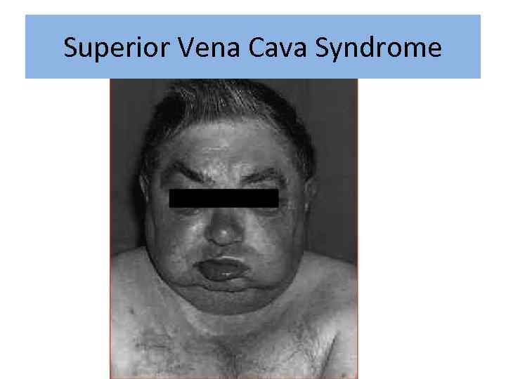 Superior Vena Cava Syndrome 