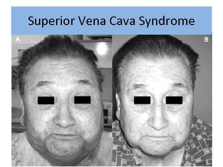 Superior Vena Cava Syndrome 