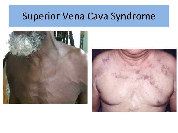 Superior Vena Cava Syndrome 