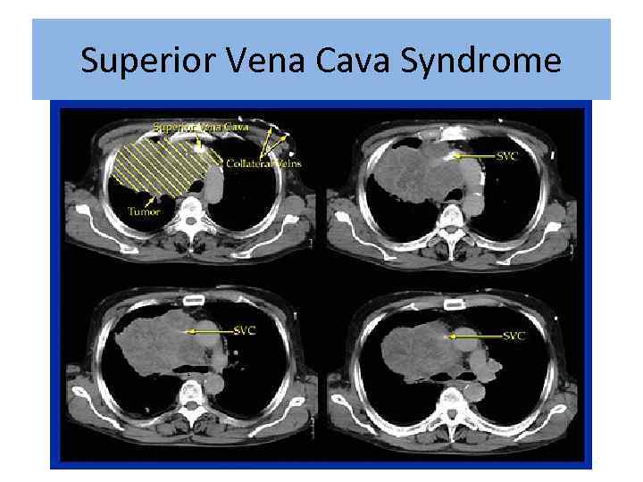 Superior Vena Cava Syndrome 