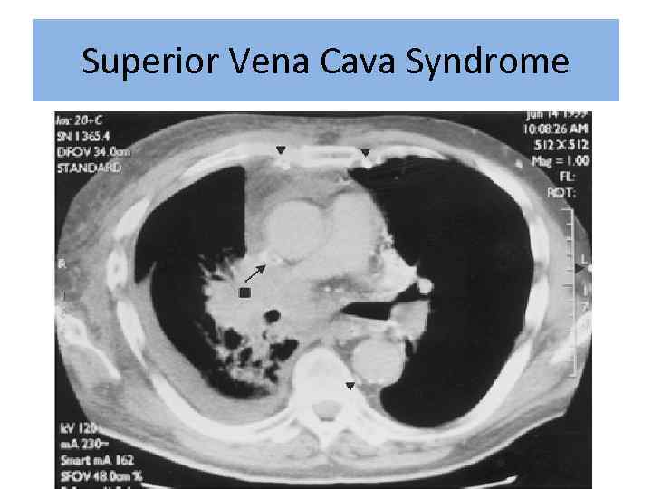 Superior Vena Cava Syndrome 