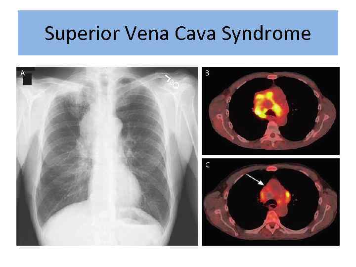 Superior Vena Cava Syndrome 