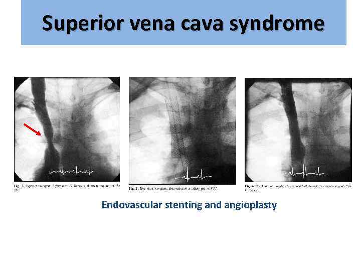 Superior vena cava syndrome Endovascular stenting and angioplasty 