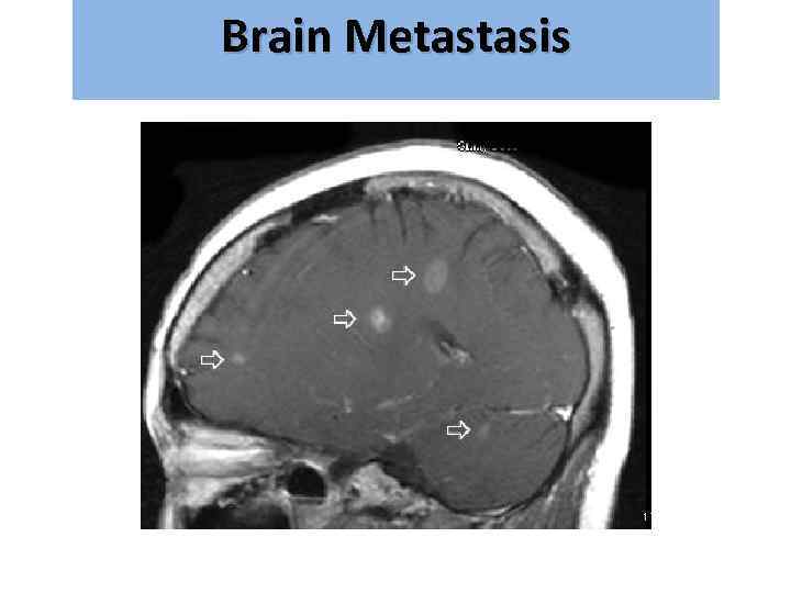 Brain Metastasis גרורות מוחיות 