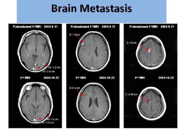 Brain Metastasis גרורות מוחיות 
