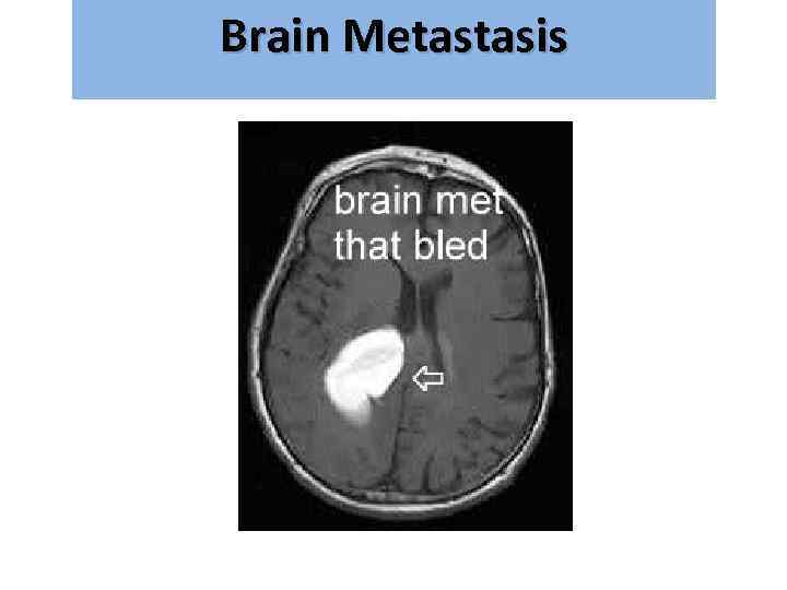 Brain Metastasis גרורות מוחיות 