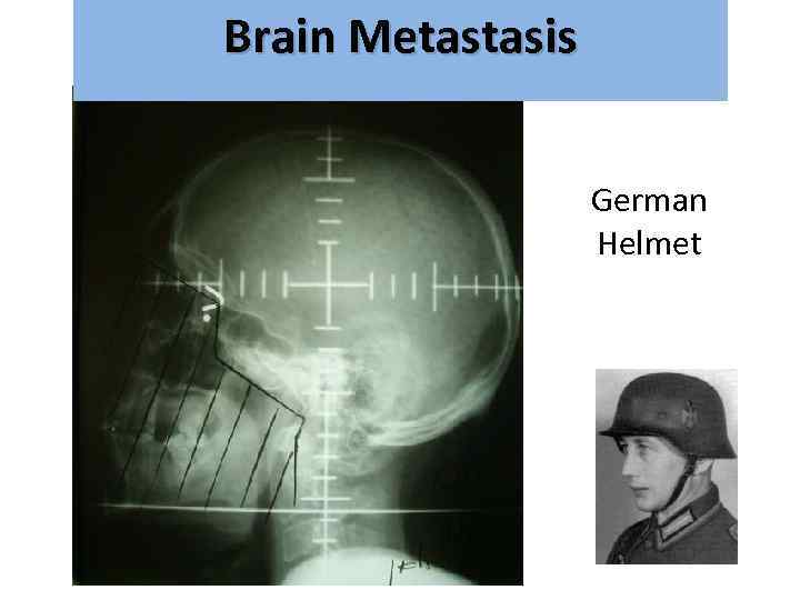 Brain Metastasis גרורות מוחיות German Helmet 