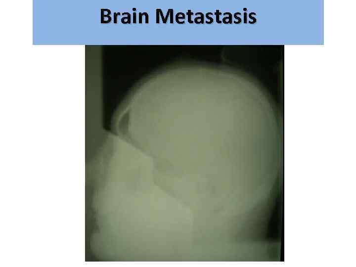 Brain Metastasis גרורות מוחיות 