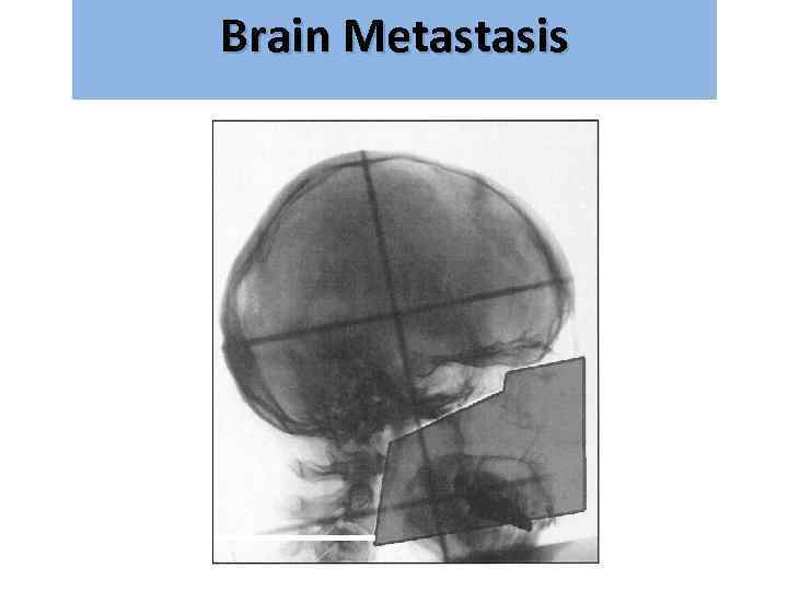 Brain Metastasis גרורות מוחיות 