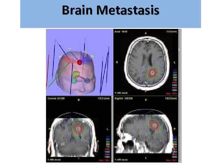 Brain Metastasis גרורות מוחיות 