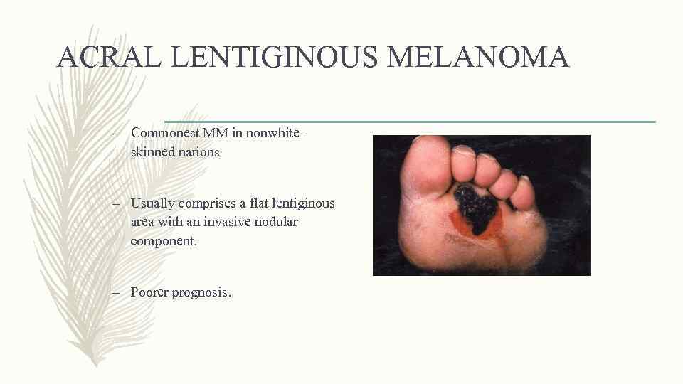 ACRAL LENTIGINOUS MELANOMA – Commonest MM in nonwhiteskinned nations – Usually comprises a flat