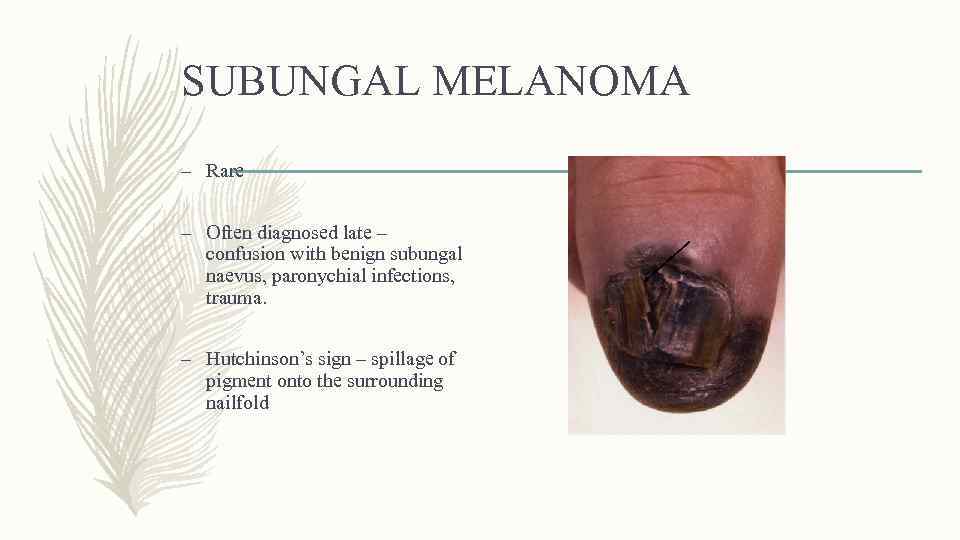 SUBUNGAL MELANOMA – Rare – Often diagnosed late – confusion with benign subungal naevus,