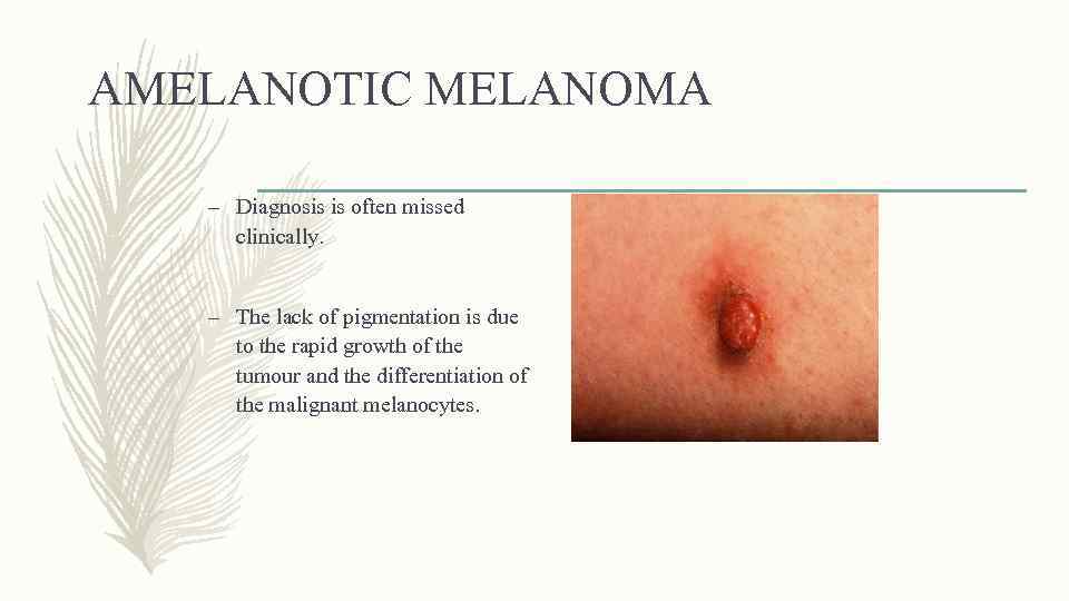 AMELANOTIC MELANOMA – Diagnosis is often missed clinically. – The lack of pigmentation is